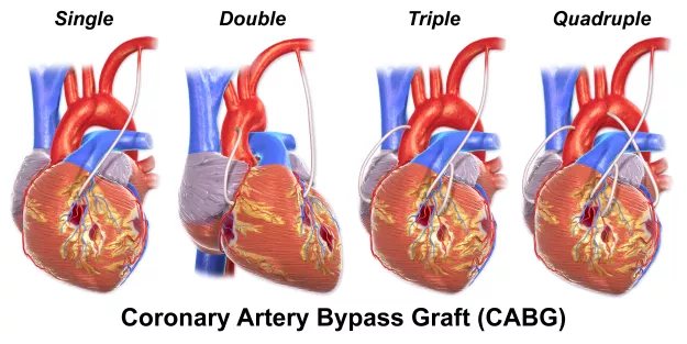 Diagram of a Coronary Artery Bypass Graft (CABG) procedure